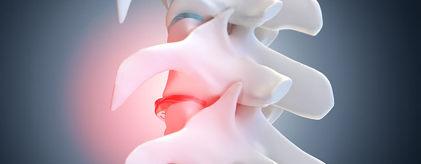 patient needing degenerative disc disease in need of spinal decompression therapy in Hayward
