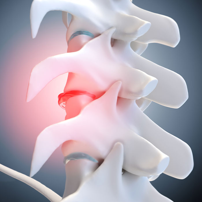 degenerative Disc Disease treatment in Hayward
