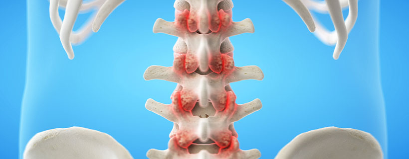 patient needing facet joint syndrome in need of spinal decompression therapy in Hayward