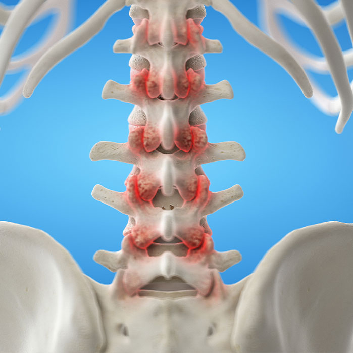 facet Joint Syndrome treatment in Hayward
