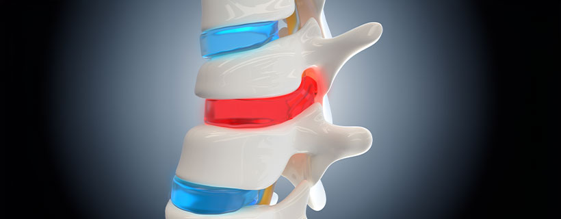 patient needing herniated disc in need of spinal decompression therapy in Hayward