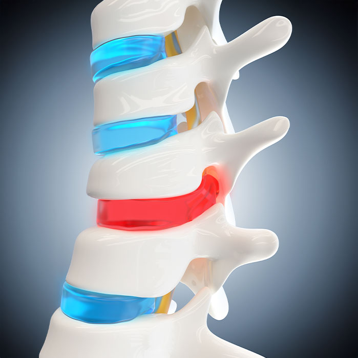 herniated Disc treatment in Hayward