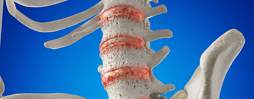 patient needing osteoarthritis in need of spinal decompression therapy in Hayward