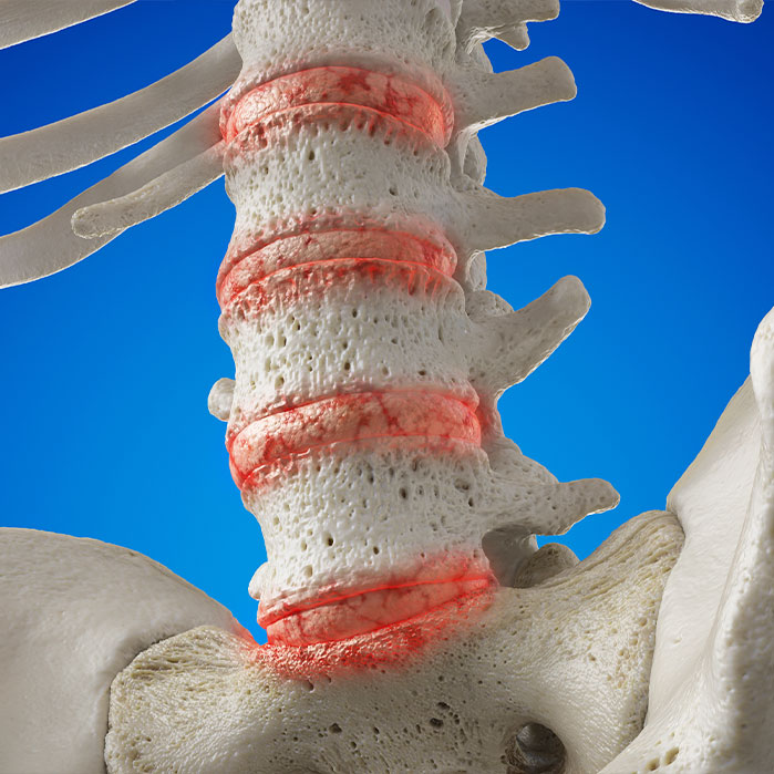 osteoarthritis treatment in Hayward