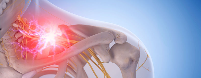 patient needing pinched nerve in need of spinal decompression therapy in Hayward
