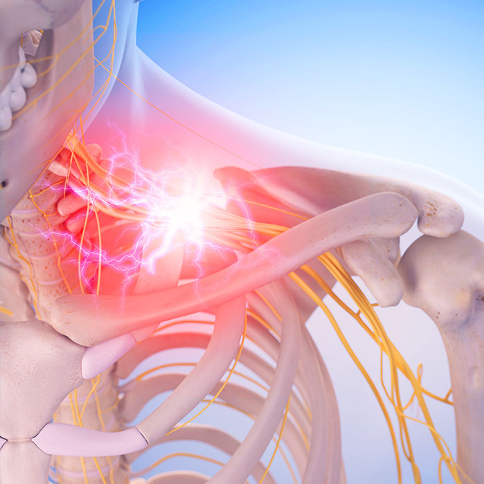 pinched nerve treatment in Hayward