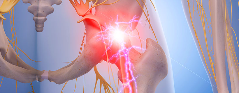patient needing sciatica in need of spinal decompression therapy in Hayward
