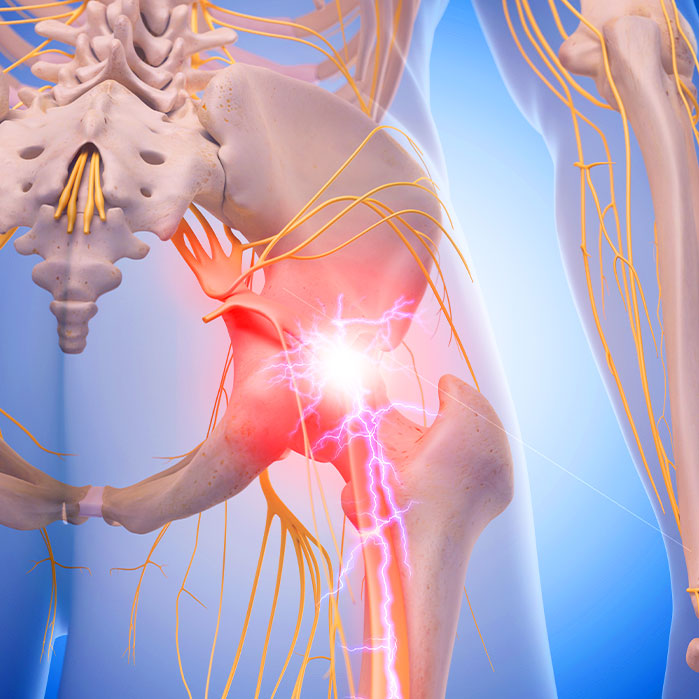sciatica treatment in Hayward