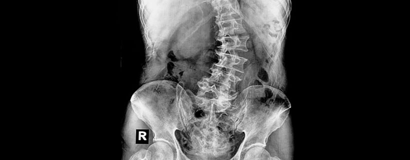 patient needing scoliosis in need of spinal decompression therapy in Hayward