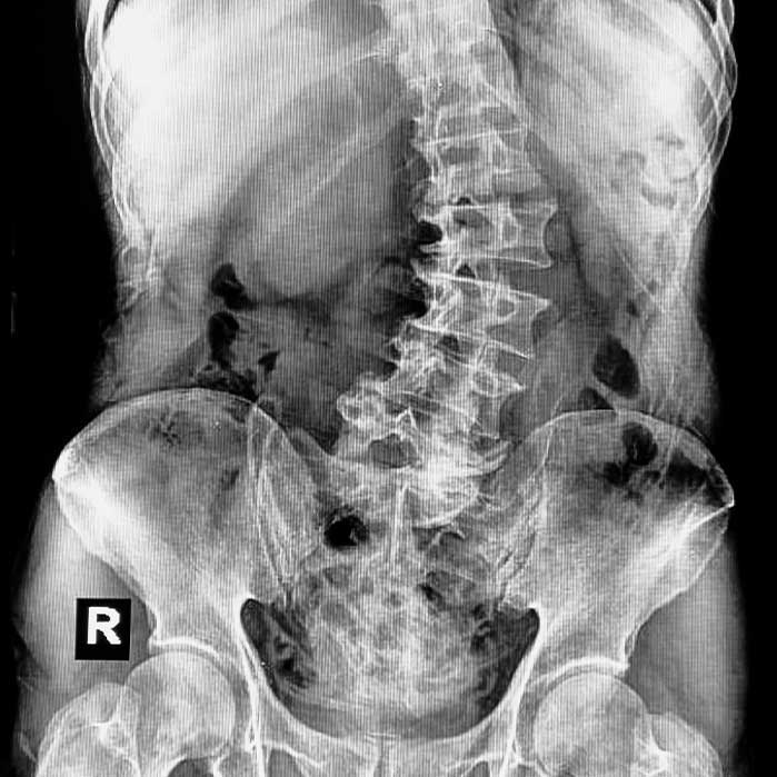 scoliosis treatment in Hayward