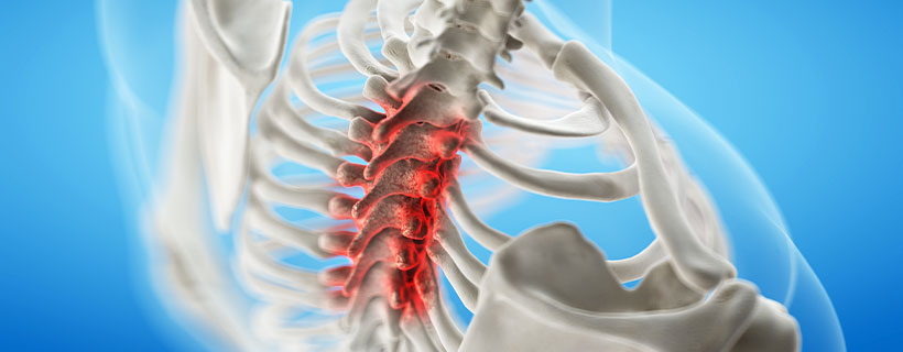 patient needing spinal stenosis in need of spinal decompression therapy in Hayward