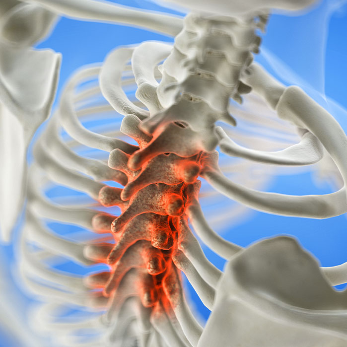 spinal Stenosis treatment in Hayward