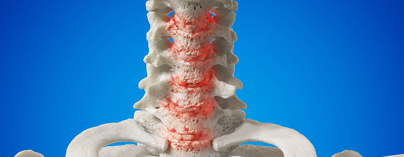 patient needing spondylosis  in need of spinal decompression therapy in Hayward