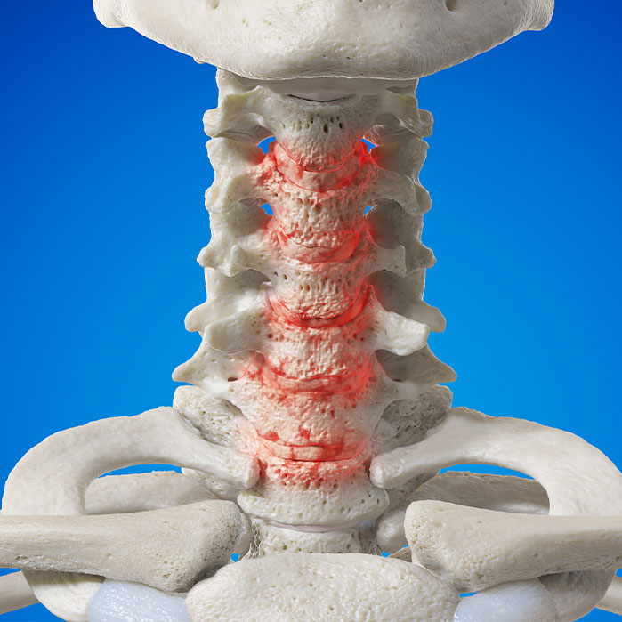spondylosis treatment in Hayward